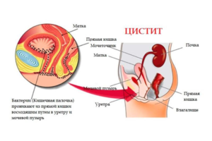 Кишечная палочка в уретре