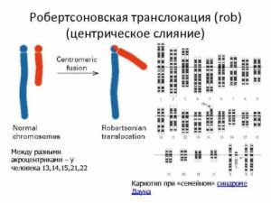 Кариотип робертсоновская транслокация