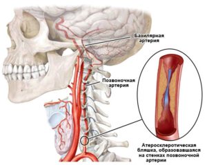 Лечение кровотока по правой позвоночной артерии