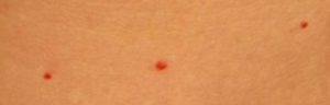Мелкие красные точки на теле от спермы