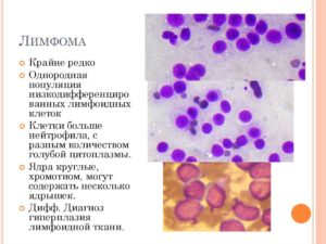 Лимфома и кортикостероиды