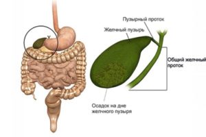 Камни и взвесь в желчном пузыре