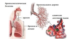 Бронхоэктатическая болезнь