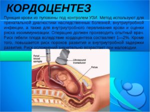 КорДоцентез