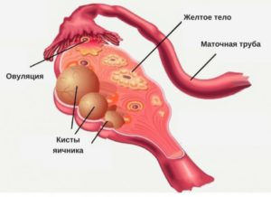 Киста яичника или овуляция