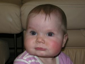 Малышу 7,5 месяцев покраснели щёчки
