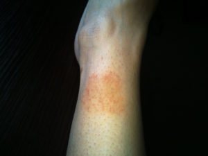 Красные пятна на голени ног, что это и как лечить?