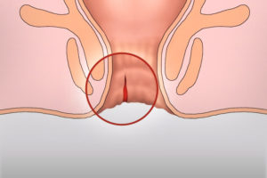 Боль в заднем проходе после дефекации