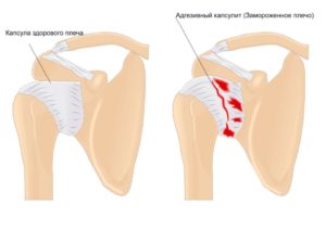 Лопнула суставная капсула