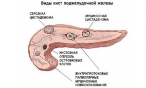 Киста поджелудочной железы