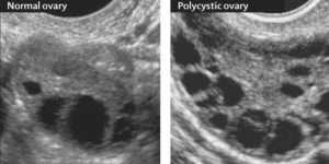 Кистозные изменения яичников