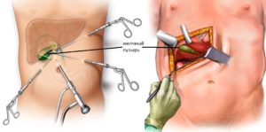 Лечение гастрита после удаления желчного пузыря