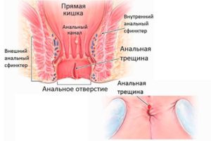 Боль в анальном отверстии