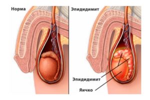 Болят яички, эпидидимит