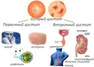 Болит почка и тошнит