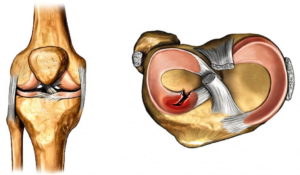 Боль в колене после операции миниска