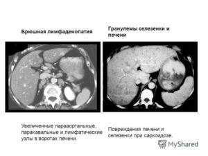 Лимфоаденопатии внутрибрюшных и забрюшных лимфоузлов