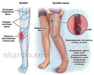 Боль в ноге. Горячая вена