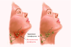 Лимфоузел слева сильно увеличен после ангины