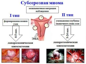 Изменение цикла после миомэктомии