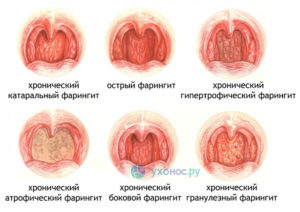 Хронический субатрофический фарингит