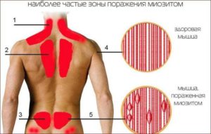 Болит бок при вдохе слева,5-й день максимальная температура 38