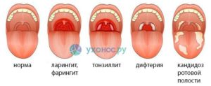 Боли в горле и полости рта, стоматит или нет