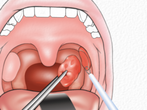 Ком в горле после тонзиллэктомии