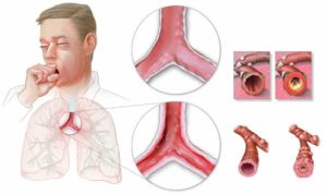 Кашель с обструкцией