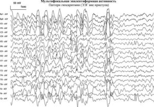 Изменения у ребенка ЭЭГ с элементами эпилептиформной активности