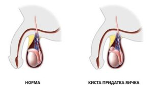 Киста головки правого придатка