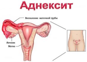 Боли в яичнике при мочеиспускании