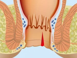 Боль в заднем проходе после дефекации