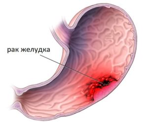 Излечима ли инфильтративная язва на ранних стадиях?