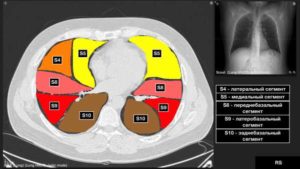 Кт-признаки очагов s2 сегмента правого легкого