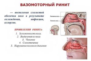 Периодическая слизь в горле, вазомоторный ринит