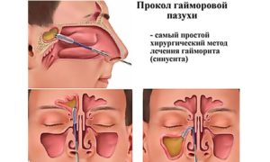 Хронический гайморит, необходима пункция, ВИЧ