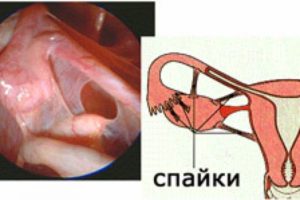 Боли на месте удаления спаек