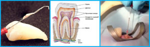 Больно ли перепломбировать зуб, если зуб с нервом?