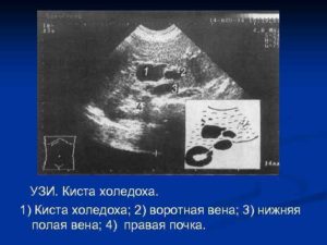 Киста холедоха после рождения