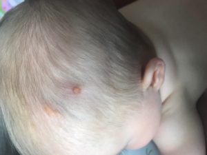 Мелкие коричневые образования на голове у ребёнка