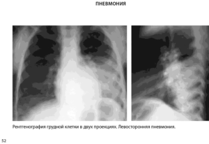 Левосторонняя пневмония без динамики