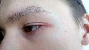 Боль в области внутреннего уголка глаза