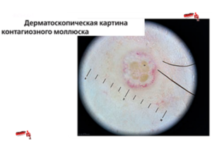 Контагиозный моллюск, плохие анализы крови и мочи