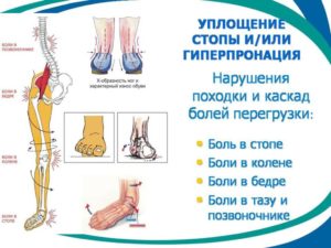 Болит поясница и плоскостопие