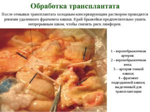Пересадка тонкой кишки новорожденному
