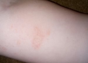 Красные пятна в складках на ножках и других частях тела