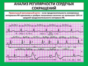 Как может влиять бисопролол на кардиограмму