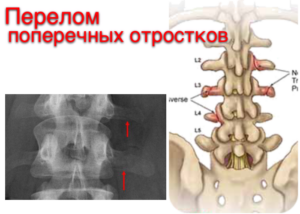 Перелом правого поперечного отростка