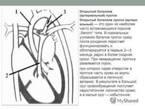 Кальцинат связки Баталова протока